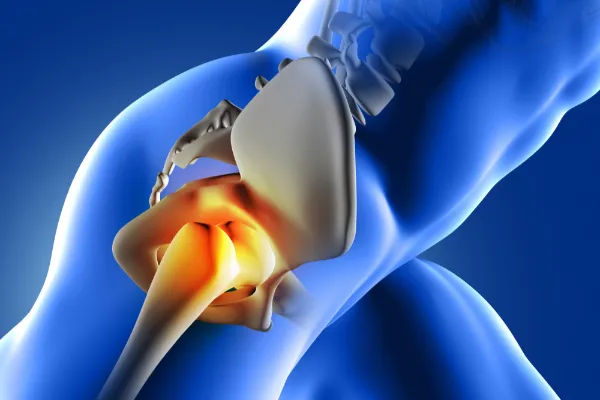 Piriformis Syndrome
