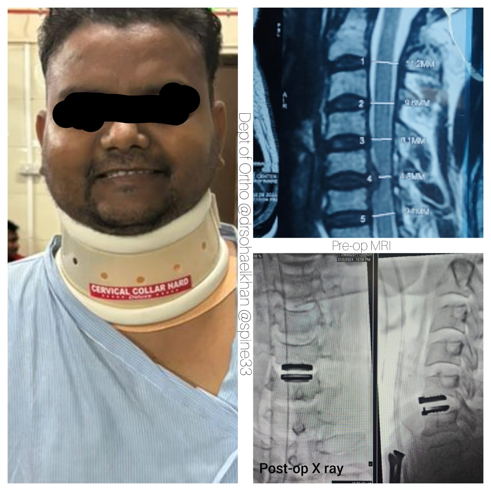 Cervical Disc Replacement Surgery done by Dr. Sohael Khan Nagpur