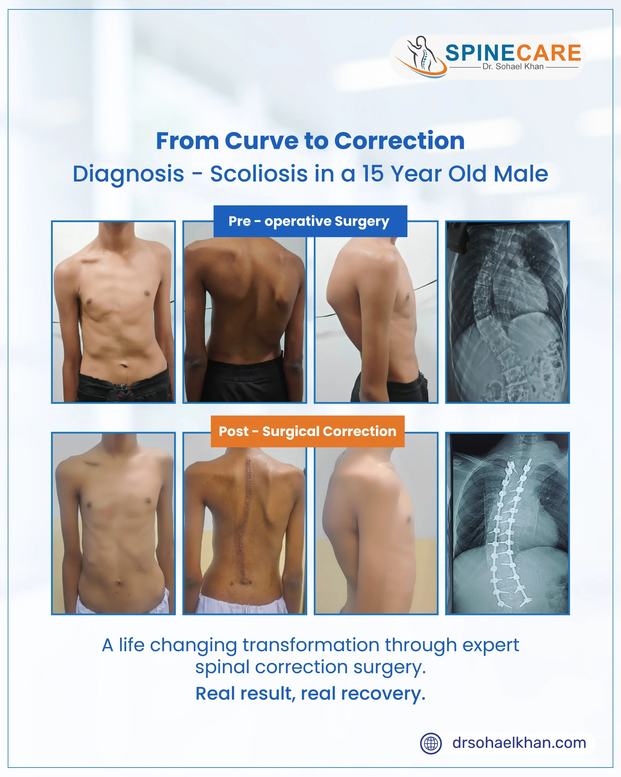From Curve to Correction, Diagnosis – Scoliosis in a 15 Year Old Male