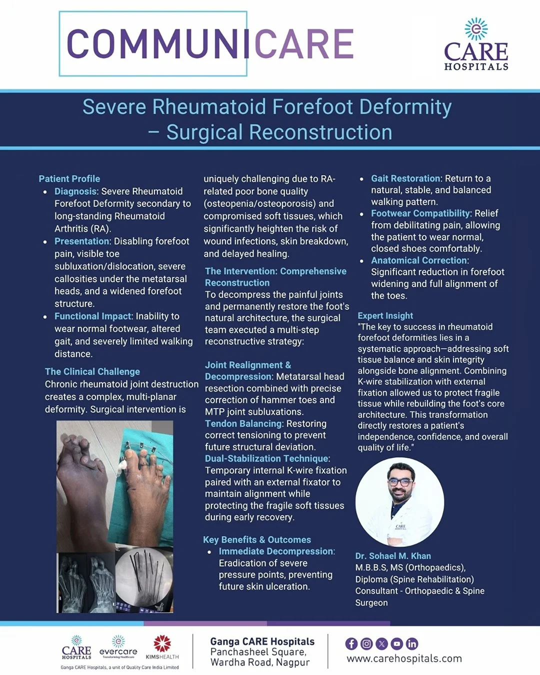 Severe Rheumatoid Forefoot Deformity – Surgical Reconstruction